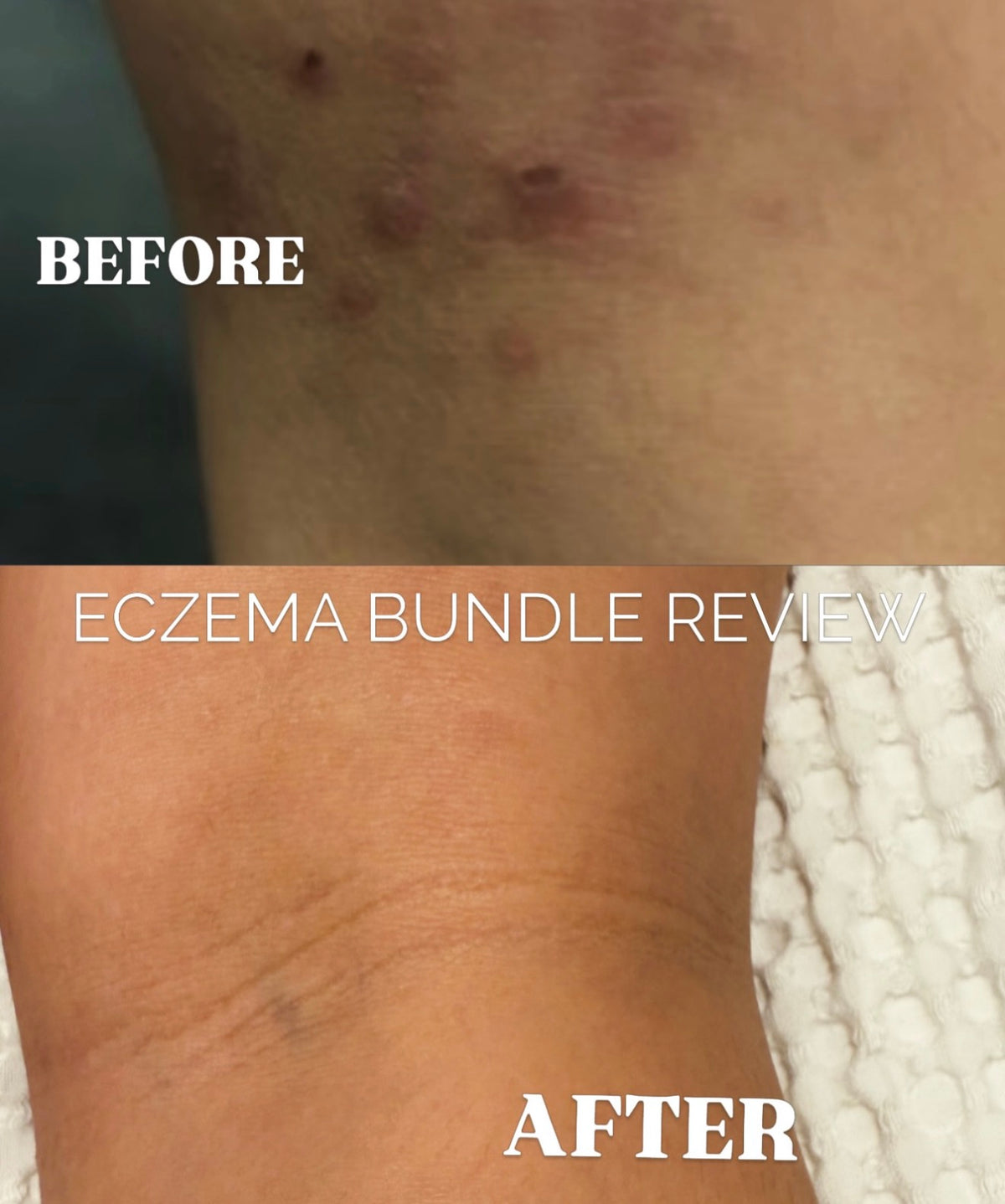 Before and after comparison of an eczema flare and healing on a person's forearm, with text overlays reading 'BEFORE', 'ECZEMA BUNDLE REVIEW', and 'AFTER'.
