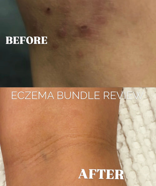 Before and after comparison of an eczema flare and healing on a person's forearm, with text overlays reading 'BEFORE', 'ECZEMA BUNDLE REVIEW', and 'AFTER'.